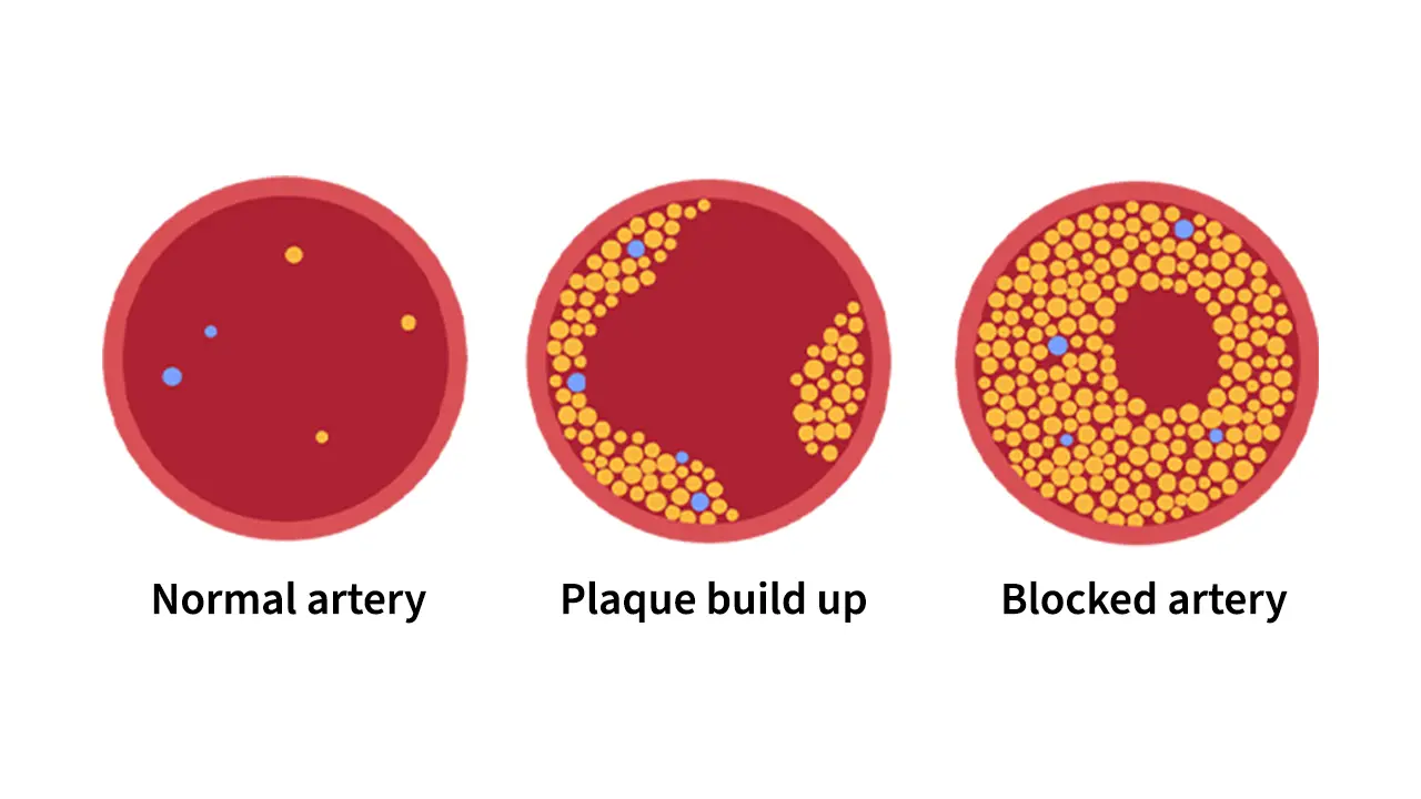 Illustration showing, three stages on what arteries look like when plaque builds up