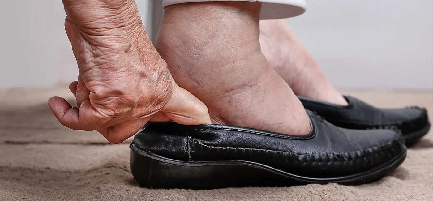 Close-up of an elderly person's hand and feet. The person is putting on black shoes. Their feet and ankles are swollen. 