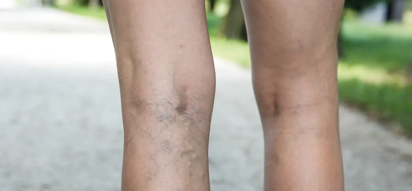 Close-up of the back of a person's knees and legs. Damaged and prominent veins are obviously visible.